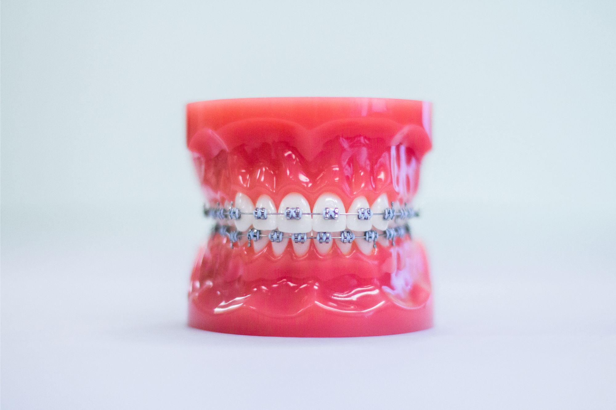 Braces Fort Collins - Metal Braces Braces Fort Collins - metal braces